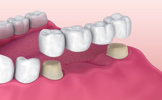 Dental Bridges