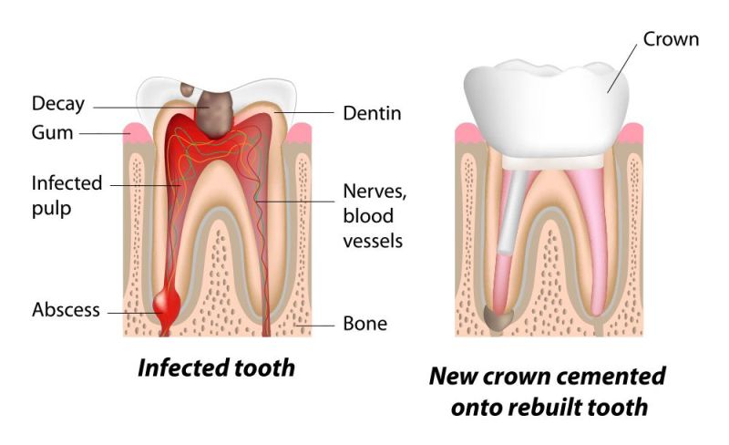 Tooth Removal